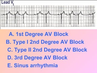 A. 1st Degree AV Block
B. Type I 2nd Degree AV Block
C. Type II 2nd Degree AV Block
D. 3rd Degree AV Block
E. Sinus arrhythmia
 