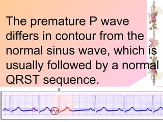 The premature P wave
differs in contour from the
normal sinus wave, which is
usually followed by a normal
QRST sequence.
 