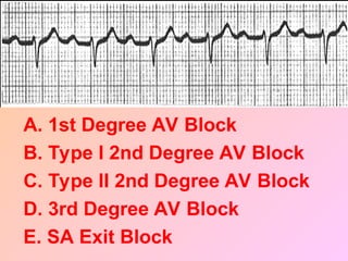 A. 1st Degree AV Block
B. Type I 2nd Degree AV Block
C. Type II 2nd Degree AV Block
D. 3rd Degree AV Block
E. SA Exit Block
 