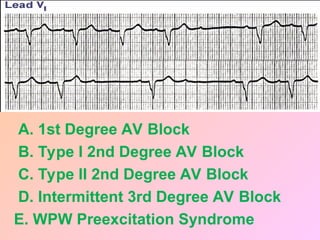 A. 1st Degree AV Block
B. Type I 2nd Degree AV Block
C. Type II 2nd Degree AV Block
D. Intermittent 3rd Degree AV Block
E. WPW Preexcitation Syndrome
 