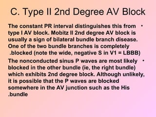C. Type II 2nd Degree AV Block
•
The constant PR interval distinguishes this from
type I AV block. Mobitz II 2nd degree AV block is
usually a sign of bilateral bundle branch disease.
One of the two bundle branches is completely
blocked (note the wide, negative S in V1 = LBBB)
.
•
The nonconducted sinus P waves are most likely
blocked in the other bundle (ie, the right bundle)
which exhibits 2nd degree block. Although unlikely,
it is possible that the P waves are blocked
somewhere in the AV junction such as the His
bundle
.
 