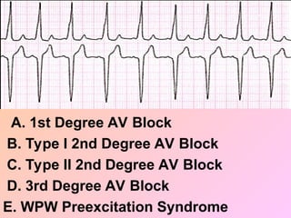 A. 1st Degree AV Block
B. Type I 2nd Degree AV Block
C. Type II 2nd Degree AV Block
D. 3rd Degree AV Block
E. WPW Preexcitation Syndrome
 