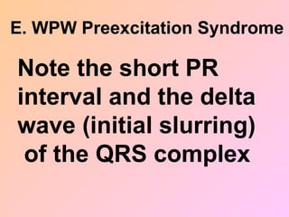 E. WPW Preexcitation Syndrome
Note the short PR
interval and the delta
wave (initial slurring)
of the QRS complex
 