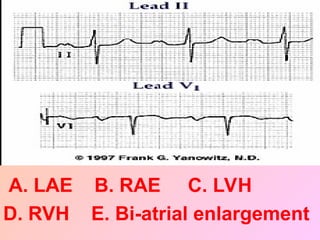 A. LAE B. RAE C. LVH
D. RVH E. Bi-atrial enlargement
 