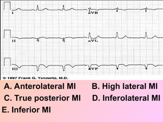 A. Anterolateral MI B. High lateral MI
C. True posterior MI D. Inferolateral MI
E. Inferior MI
 