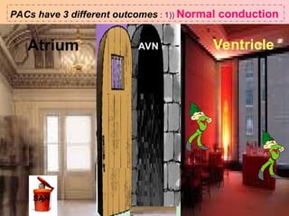 Atrium AVN Ventricle
SAN
PACs have 3 different outcomes : 1)) Normal conduction
 