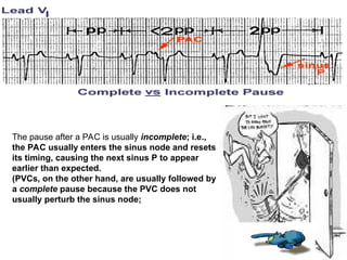 The pause after a PAC is usually incomplete; i.e.,
the PAC usually enters the sinus node and resets
its timing, causing the next sinus P to appear
earlier than expected.
(PVCs, on the other hand, are usually followed by
a complete pause because the PVC does not
usually perturb the sinus node;
 