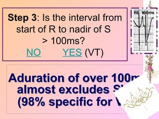 Aduration of over 100ms
almost excludes SVT
(98% specific for VT).
Step 3: Is the interval from
start of R to nadir of S
> 100ms?
NO YES (VT)
 