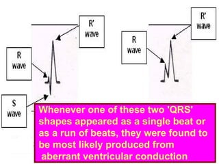 Whenever one of these two 'QRS'
shapes appeared as a single beat or
as a run of beats, they were found to
be most likely produced from
aberrant ventricular conduction
 