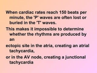 When cardiac rates reach 150 beats per
minute, the 'P' waves are often lost or
buried in the 'T' waves.
This makes it impossible to determine
whether the rhythms are produced by
an
ectopic site in the atria, creating an atrial
tachycardia,
or in the AV node, creating a junctional
tachycardia
 