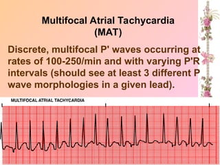 Multifocal Atrial Tachycardia
(MAT)
Discrete, multifocal P' waves occurring at
rates of 100-250/min and with varying P'R
intervals (should see at least 3 different P
wave morphologies in a given lead).
.
 