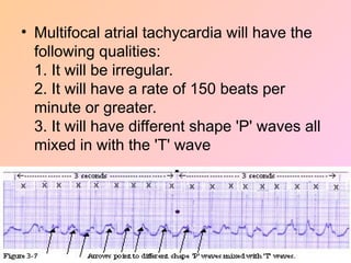 • Multifocal atrial tachycardia will have the
following qualities:
1. It will be irregular.
2. It will have a rate of 150 beats per
minute or greater.
3. It will have different shape 'P' waves all
mixed in with the 'T' wave
 