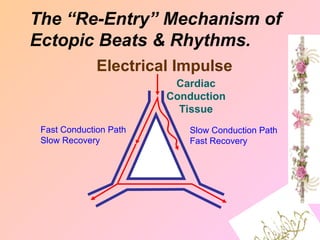 Fast Conduction Path
Slow Recovery
Slow Conduction Path
Fast Recovery
The “Re-Entry” Mechanism of
Ectopic Beats & Rhythms.
Electrical Impulse
Cardiac
Conduction
Tissue
 