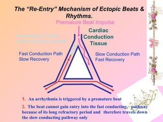 Fast Conduction Path
Slow Recovery
Slow Conduction Path
Fast Recovery
Premature Beat Impulse
Cardiac
Conduction
Tissue
1. An arrhythmia is triggered by a premature beat
2. The beat cannot gain entry into the fast conducting pathway
because of its long refractory period and therefore travels down
the slow conducting pathway only
Repolarizing Tissue
(long refractory period)
The “Re-Entry” Mechanism of Ectopic Beats &
Rhythms.
 