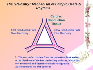 3. The wave of excitation from the premature beat arrives
at the distal end of the fast conducting pathway, which has
now recovered and therefore travels retrogradely
(backwards) up the fast pathway
Fast Conduction Path
Slow Recovery
Slow Conduction Path
Fast Recovery
Cardiac
Conduction
Tissue
The “Re-Entry” Mechanism of Ectopic Beats &
Rhythms.
 