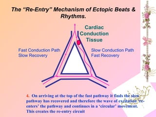 4. On arriving at the top of the fast pathway it finds the slow
pathway has recovered and therefore the wave of excitation ‘re-
enters’ the pathway and continues in a ‘circular’ movement.
This creates the re-entry circuit
Fast Conduction Path
Slow Recovery
Slow Conduction Path
Fast Recovery
Cardiac
Conduction
Tissue
The “Re-Entry” Mechanism of Ectopic Beats &
Rhythms.
 