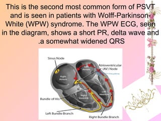This is the second most common form of PSVT
and is seen in patients with Wolff-Parkinson-
White (WPW) syndrome. The WPW ECG, seen
in the diagram, shows a short PR, delta wave and
a somewhat widened QRS
.
 