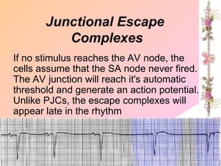 If no stimulus reaches the AV node, the
cells assume that the SA node never fired.
The AV junction will reach it's automatic
threshold and generate an action potential.
Unlike PJCs, the escape complexes will
appear late in the rhythm
Junctional Escape
Complexes
 