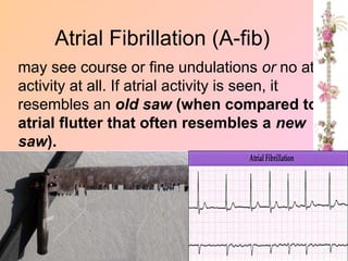 may see course or fine undulations or no atrial
activity at all. If atrial activity is seen, it
resembles an old saw (when compared to
atrial flutter that often resembles a new
saw).
Atrial Fibrillation (A-fib)
 