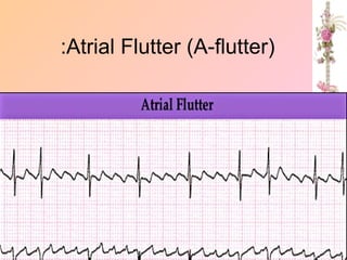 Atrial Flutter (A-flutter)
:
 