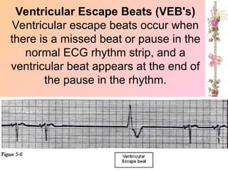 Ventricular Escape Beats (VEB's)
Ventricular escape beats occur when
there is a missed beat or pause in the
normal ECG rhythm strip, and a
ventricular beat appears at the end of
the pause in the rhythm.
 