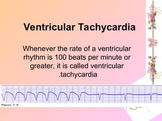 Whenever the rate of a ventricular
rhythm is 100 beats per minute or
greater, it is called ventricular
tachycardia
.
Ventricular Tachycardia
 