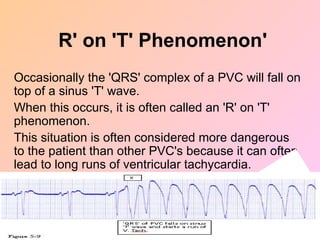 Occasionally the 'QRS' complex of a PVC will fall on
top of a sinus 'T' wave.
When this occurs, it is often called an 'R' on 'T'
phenomenon.
This situation is often considered more dangerous
to the patient than other PVC's because it can often
lead to long runs of ventricular tachycardia.
'
R' on 'T' Phenomenon
 