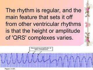 The rhythm is regular, and the
main feature that sets it off
from other ventricular rhythms
is that the height or amplitude
of 'QRS' complexes varies.
 