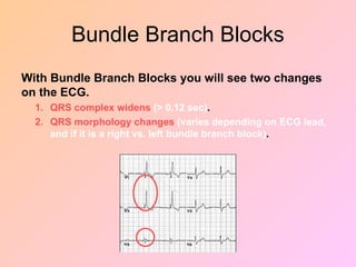 Bundle Branch Blocks
With Bundle Branch Blocks you will see two changes
on the ECG.
1. QRS complex widens (> 0.12 sec).
2. QRS morphology changes (varies depending on ECG lead,
and if it is a right vs. left bundle branch block).
 