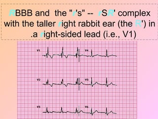 RBBB and the "r's" -- rSR' complex
with the taller right rabbit ear (the R') in
a right-sided lead (i.e., V1)
.
 