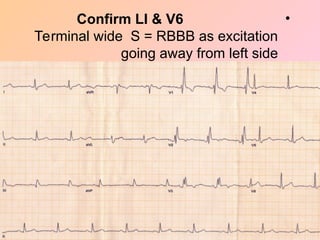 •
Confirm LI & V6
Terminal wide S = RBBB as excitation
going away from left side
 