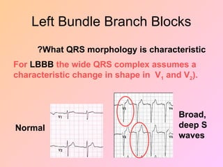Left Bundle Branch Blocks
What QRS morphology is characteristic
?
For LBBB the wide QRS complex assumes a
characteristic change in shape in V1 and V2).
Broad,
deep S
waves
Normal
 
