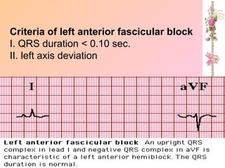 Criteria of left anterior fascicular block
I. QRS duration < 0.10 sec.
II. left axis deviation
 
