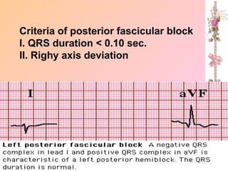 Criteria of posterior fascicular block
I. QRS duration < 0.10 sec.
II. Righy axis deviation
 