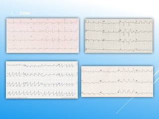 Stemi Practice Test ECG Interpretation for nurses A Step-by-Step Guide to Analyze ECG ...