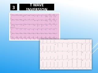 ECG Interpretation for nurses A Step-by-Step Guide to Analyze ECG ...