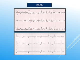 ECG Interpretation for nurses A Step-by-Step Guide to Analyze ECG ...