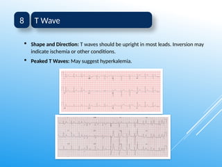 ECG Interpretation for nurses A Step-by-Step Guide to Analyze ECG ...