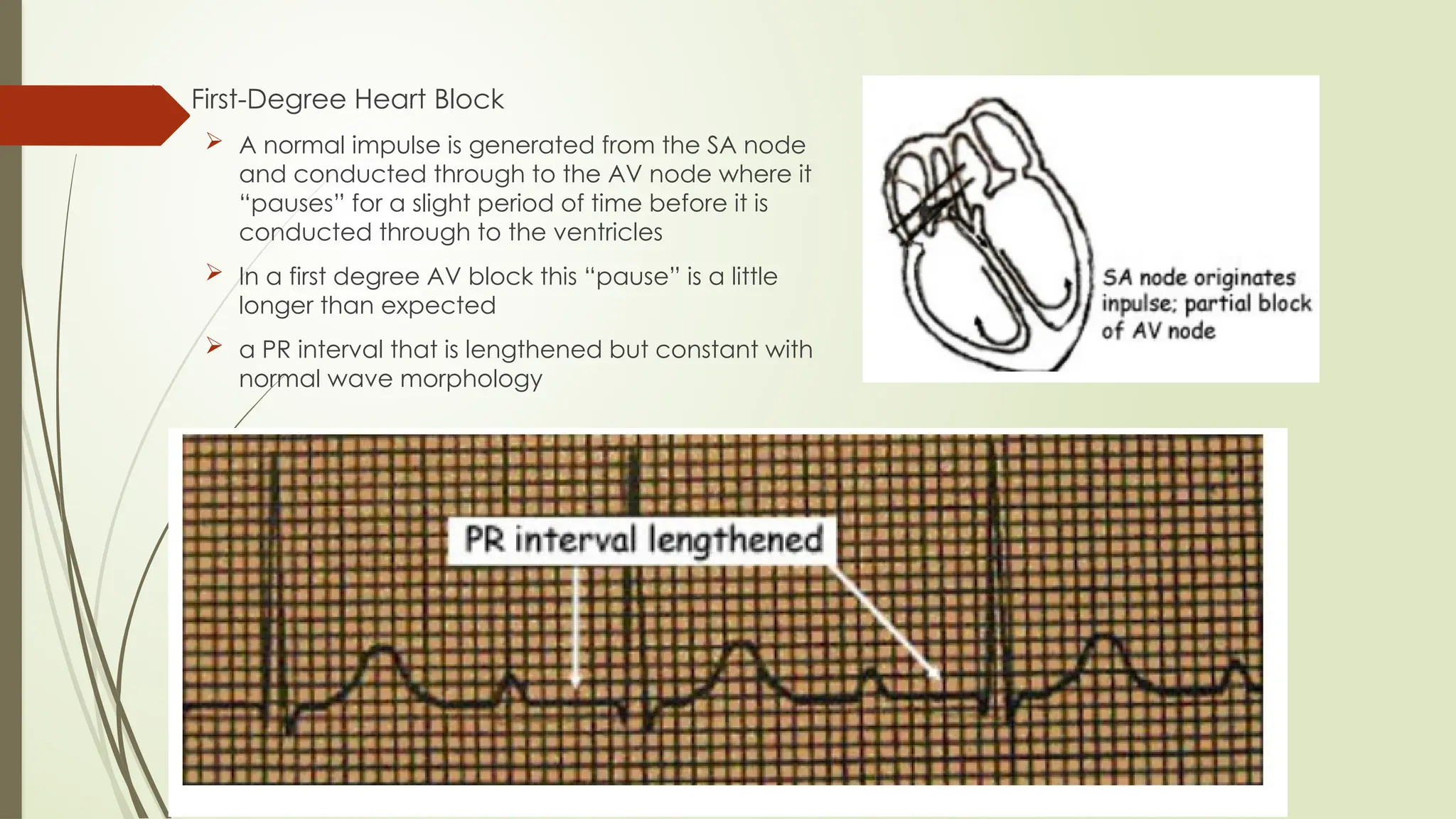 ECG reading and interpretation for beginners.pptx