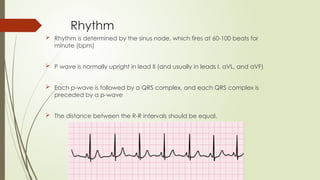 Rhythm
 Rhythm is determined by the sinus node, which fires at 60-100 beats for
minute (bpm)
 P wave is normally upright in lead II (and usually in leads I, aVL, and aVF)
 Each p-wave is followed by a QRS complex, and each QRS complex is
preceded by a p-wave
 The distance between the R-R intervals should be equal.
 