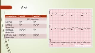 Axis
Interpretation Lead I Lead aVF
ORS direction
Normal UP UP
Left axis
deviation
UP DOWN
Right axis
deviation
DOWN UP
Extreme axis
deviation
DOWN DOWN
 