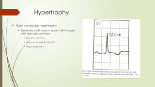Hypertrophy
 Right ventricular hypertrophy
 Relatively tall R wave in lead V1(R>S wave)
with right axis deviation
 R in V1 >= 0.7mV
 R/S in V1>1 with R> 0.5 mV
 R/S in V4 or V6 < 1
 