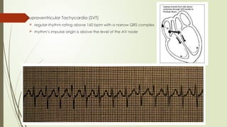  Supraventricular Tachycardia (SVT)
 regular rhythm rating above 160 bpm with a narrow QRS complex
 rhythm’s impulse origin is above the level of the AV node
 