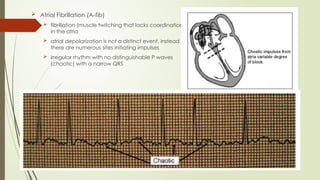  Atrial Fibrillation (A-fib)
 fibrillation (muscle twitching that lacks coordination)
in the atria
 atrial depolarization is not a distinct event, instead
there are numerous sites initiating impulses
 irregular rhythm with no distinguishable P waves
(chaotic) with a narrow QRS
 