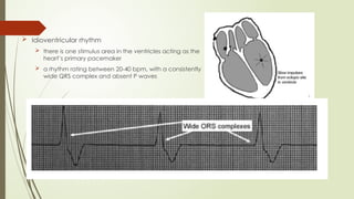  Idioventricular rhythm
 there is one stimulus area in the ventricles acting as the
heart’s primary pacemaker
 a rhythm rating between 20-40 bpm, with a consistently
wide QRS complex and absent P waves
 
