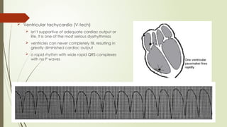  Ventricular tachycardia (V-tech)
 isn’t supportive of adequate cardiac output or
life. It is one of the most serious dysrhythmias
 ventricles can never completely fill, resulting in
greatly diminished cardiac output
 a rapid rhythm with wide rapid QRS complexes
with no P waves
 