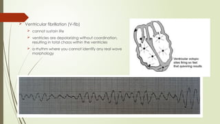  Ventricular fibrillation (V-fib)
 cannot sustain life
 ventricles are depolarizing without coordination,
resulting in total chaos within the ventricles
 a rhythm where you cannot identify any real wave
morphology
 