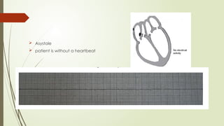  Asystole
 patient is without a heartbeat
 