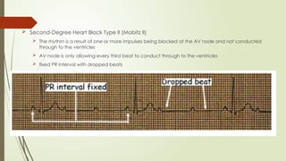  Second-Degree Heart Block Type II (Mobitz II)
 The rhythm is a result of one or more impulses being blocked at the AV node and not conducted
through to the ventricles
 AV node is only allowing every third beat to conduct through to the ventricles
 fixed PR interval with dropped beats
 