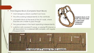  Third-Degree Block (Complete Heart Block)
 most dangerous block a patient can have
 the atria working independently to the ventricles
 complete block at the level of the AV node, where
impulses are unable to pass through
 two pacemakers in the heart operating independently
 a rhythm with constant P waves, a varying PR interval, with
no association to a widened QRS complex, with regular
dropped beats
 